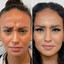 WrinkleFix: Botox (Existing Customers)