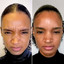 WrinkleFix: Botox (Existing Customers)