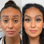 WrinkleFix: Botox (First-Time)