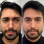 WrinkleFix: Botox (First-Time)