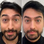 WrinkleFix: Botox (First-Time)