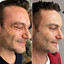 WrinkleFix: Botox (First-Time)