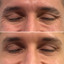 WrinkleFix: Botox (First-Time)