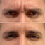 WrinkleFix: Botox (First-Time)