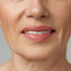 WrinkleFix: DAO Botox