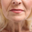 WrinkleFix: Smoker's Lines