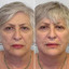 WrinkleFix: Smoker's Lines