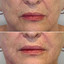 WrinkleFix: Smoker's Lines