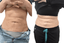 AbFix: truSculpt iD