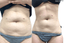 AbFix: truSculpt iD