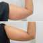 BodyFix: CoolSculpting® Elite