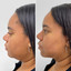 BodyFix: CoolSculpting® Elite