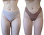 BodyFix: CoolSculpting® Elite