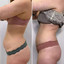 BodyFix: CoolSculpting® Elite