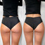BootyFix: Radiesse Butt Lift