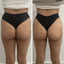 BootyFix: Sculptra Butt Lift