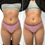 BootyFix: Sculptra Butt Lift