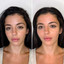 CheekFix: Filler