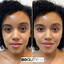 CheekFix: Filler