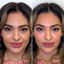 CheekFix: Filler