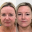 FaceFix: Sculptra