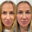 FaceFix: Sculptra