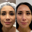 FaceFix: Sculptra