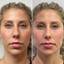 FaceFix: Sculptra