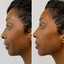 FaceFix: Sculptra