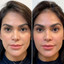 FaceFix: Sculptra