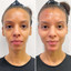FaceFix: Sculptra