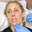 FaceFix: Sculptra