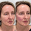 FaceFix: Thread Lift