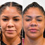 FaceFix: Thread Lift
