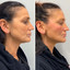 FaceFix: Thread Lift