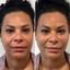 FaceFix: Thread Lift