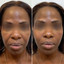 FaceFix: Thread Lift