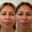 FaceFix: Thread Lift