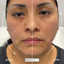 FaceFix: Thread Lift