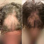 HairFix: Exosomes