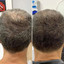 HairFix: Exosomes