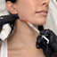 JawlineFix: Filler