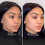 JawlineFix: Filler