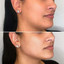 JawlineFix: Filler