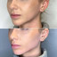JawlineFix: Filler