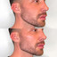 JawlineFix: Filler