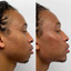 JawlineFix: Filler