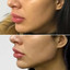 JawlineFix: Filler