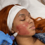 SkinFix: Microneedling + Plasma