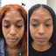 SkinFix: Microneedling + Plasma